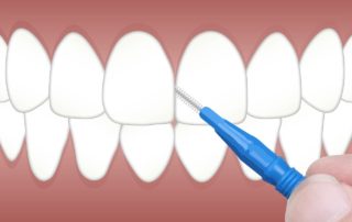 Zahnzwischenräume reinigen